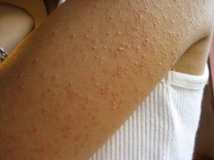Understanding Keratosis Pilaris and Its Treatment